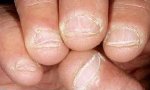 شکستگی ناخن ها در پی تماس بیش از حد با آب و مواد شوینده شکستگی ناخن ها در پی تماس بیش از حد با آب و مواد شوینده