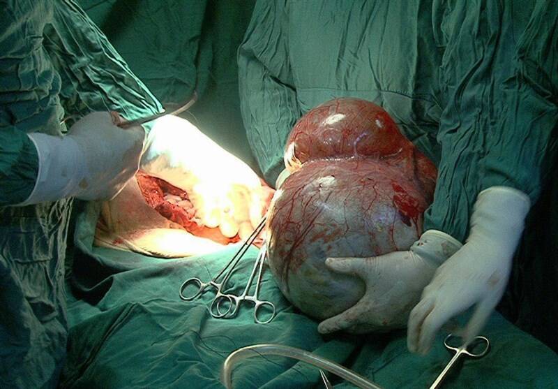 خارج کردن تومور ۹ کیلویی از شکم مرد ۷۵ ساله یاسوجی