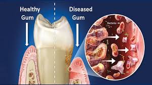 آیا بیماری لثه در تشدید کرونا موثر است؟