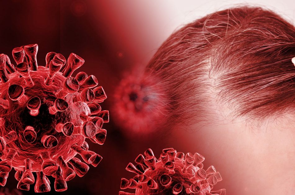 رابطه طاسی و احتمال درگیری با کرونای شدیدتر