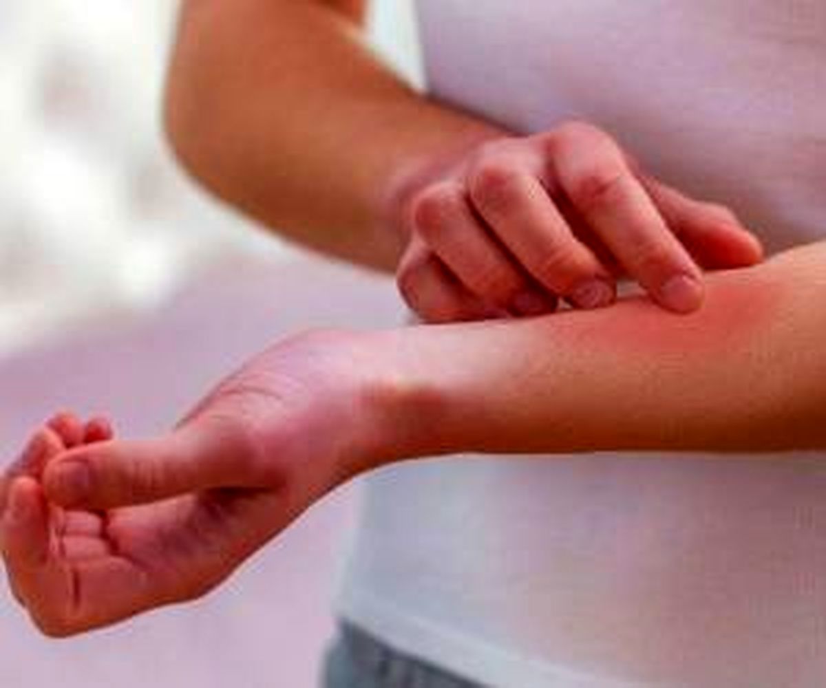 بهترین راه‌ها برای از بین بردن نیش حشره