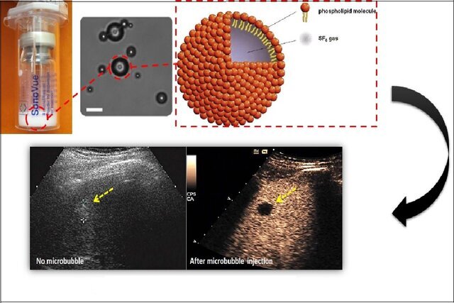 تولید میکروحبابهای لیپیدی برای ارتقای دقت تصویربرداری سونوگرافی تولید میکروحبابهای لیپیدی برای ارتقای دقت تصویربرداری سونوگرافی