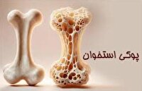 پویش ملی سلامت استخوان در گلستان